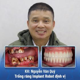 Trồng răng implant 4.0 bằng Robot định vị: An toàn - Không đau - Chính xác tuyệt đối